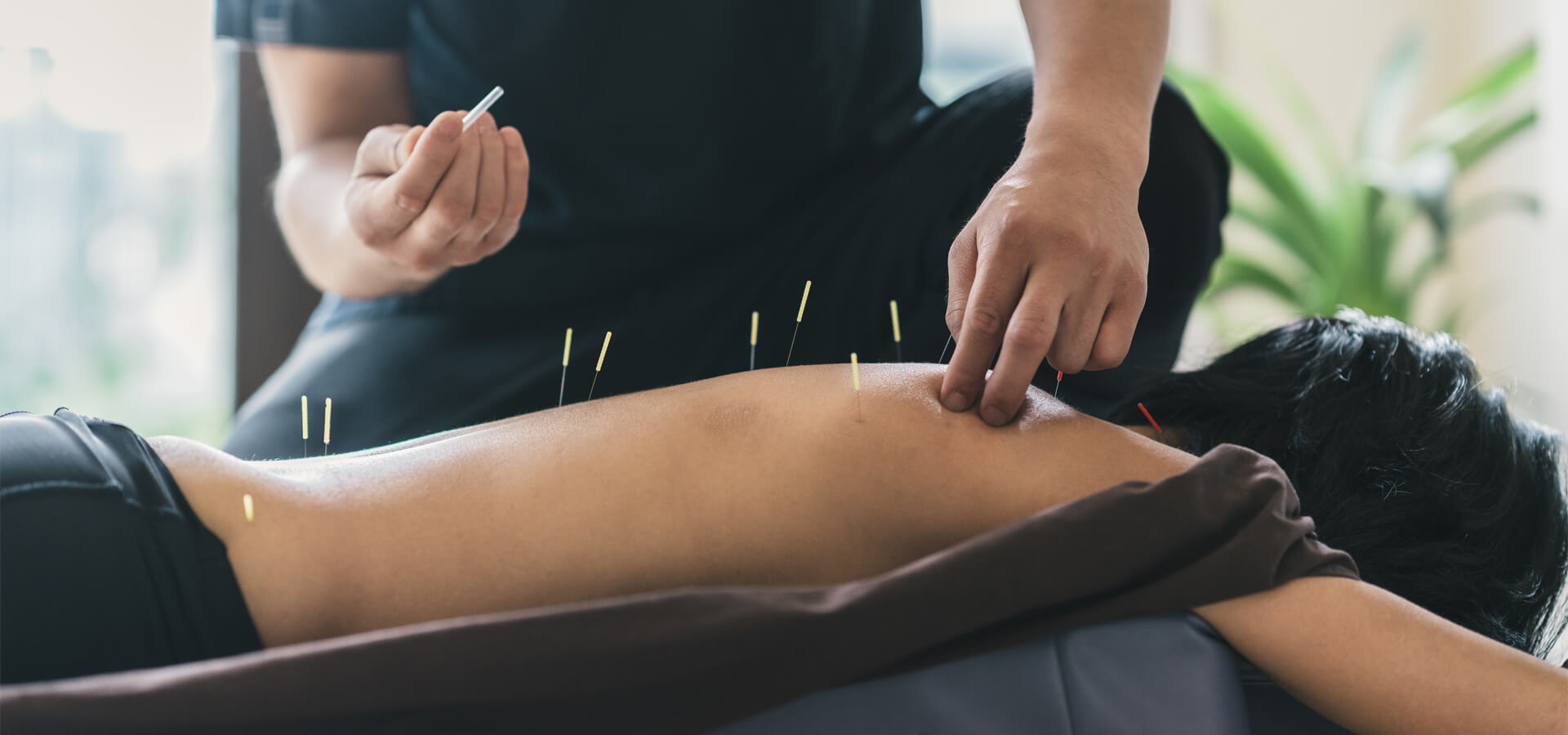 背中に鍼治療をしている