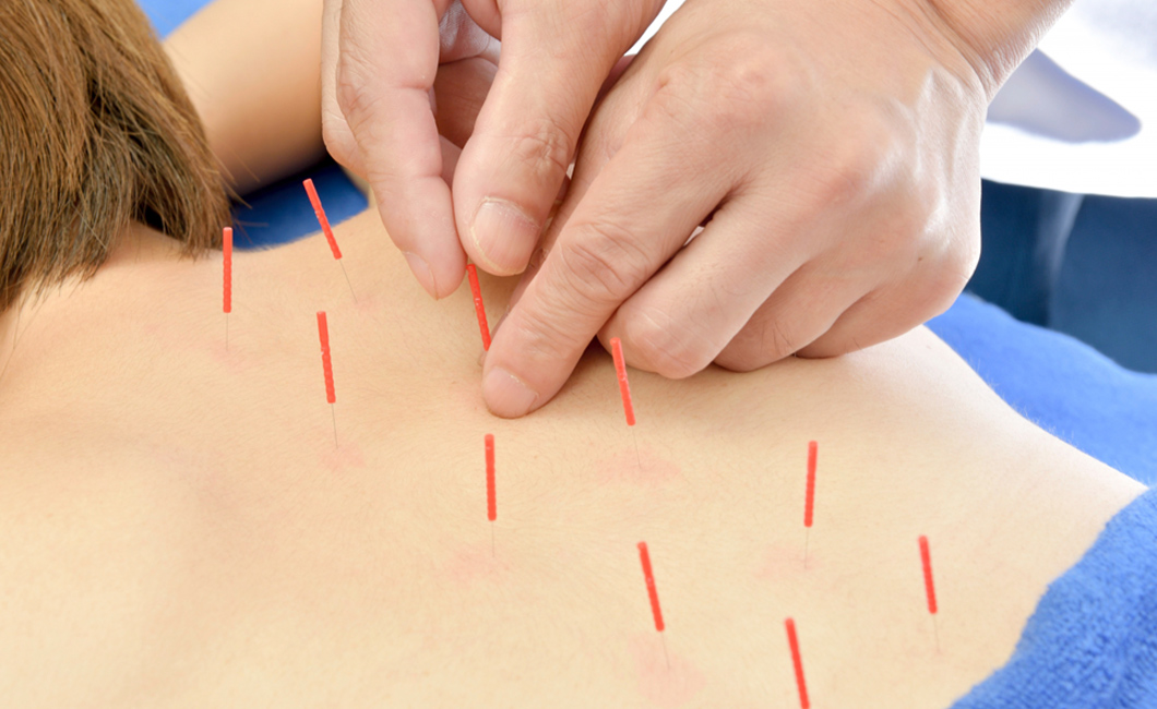 背中に鍼治療をしている